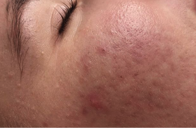 Acne behandeling — na