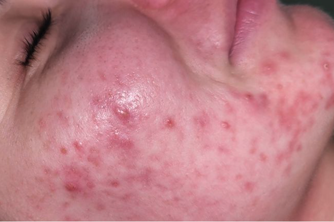 Acne behandeling — voor