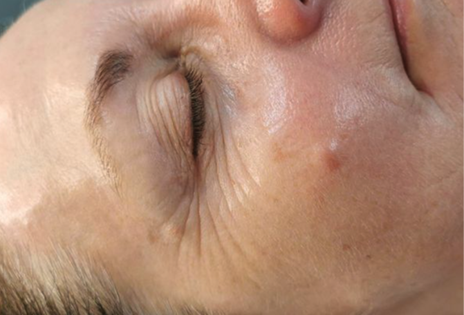 Anti-aging behandeling — na