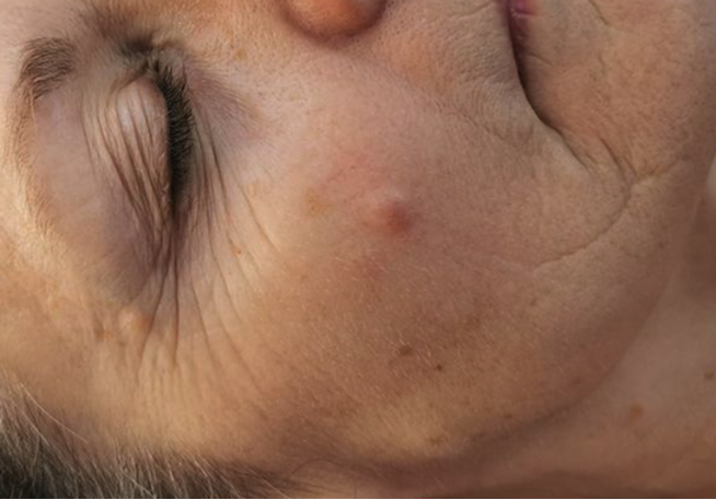 Anti-aging behandeling — voor